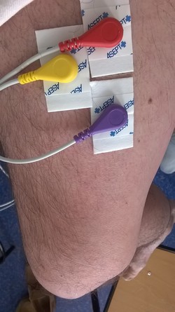 EMG_electrodes_rotulien.jpg